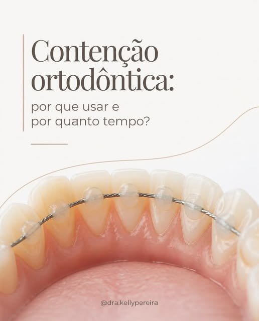 Contenção ortodôntica: por que usar e por quanto tempo? - Dra. Kelly Pereira, ortodontista em Ribeirão Preto
